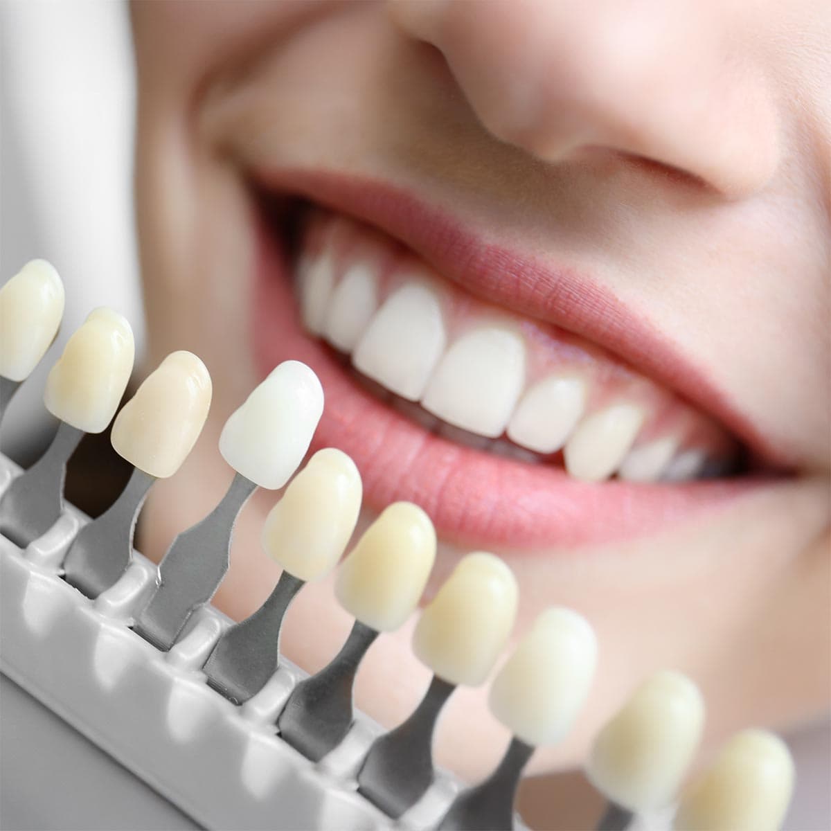 Teeth Whitening